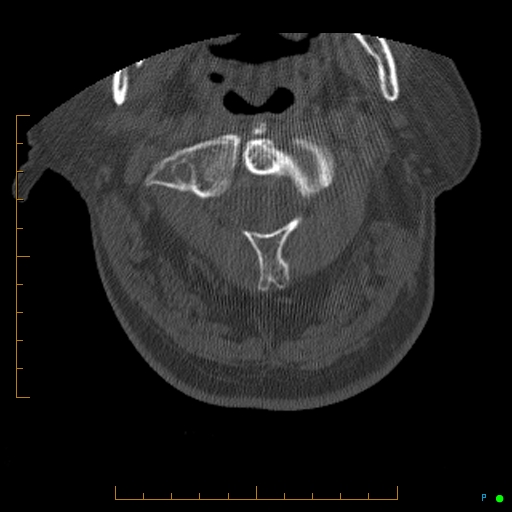 Cervical spine fracture - ankylosing spondylitis (Radiopaedia 76835-88706 Axial bone window 41).jpg