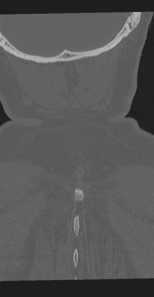 Cervical spine fracture in the setting of ankylosis (Radiopaedia 37038-38715 Coronal bone window 69).png