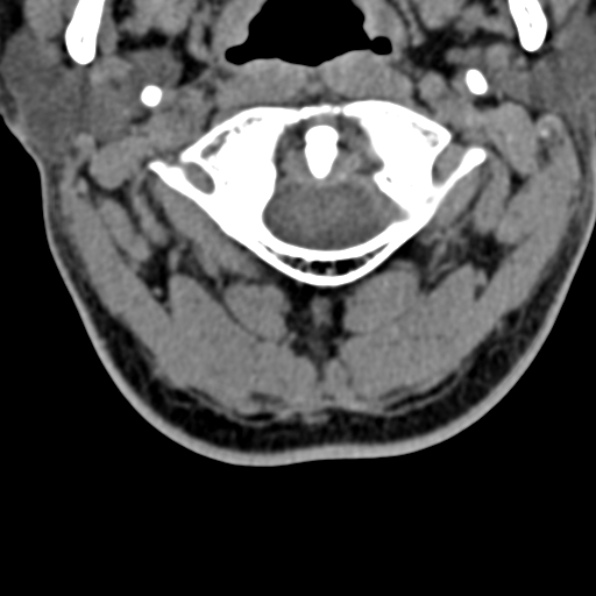 Cervical spondylodiscitis (Radiopaedia 28057-29489 Axial non-contrast 16).jpg