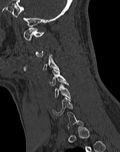 Cervical spondylodiscitis (Radiopaedia 28057-29489 Sagittal bone window 47).jpg