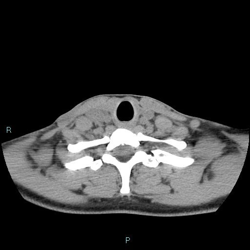 Cervical thymic cyst (Radiopaedia 88632-105335 Axial non-contrast 38).jpg