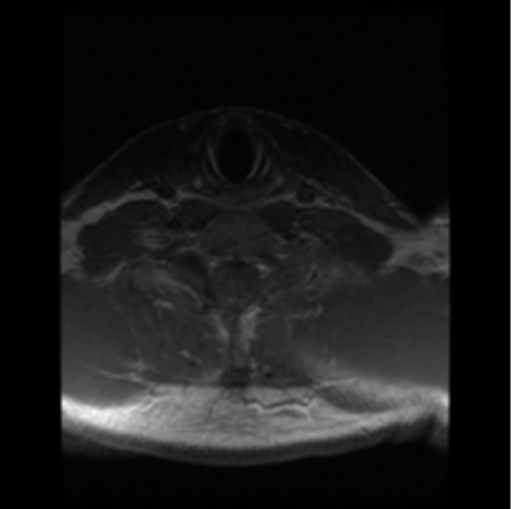 File:Cervical vertebrae metastasis (Radiopaedia 78814-91667 Axial T1 C+ 2).png