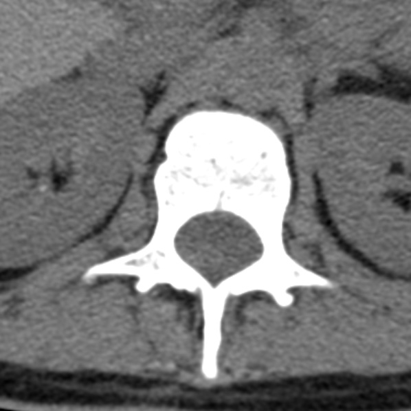 File:Chance fracture (Radiopaedia 36521-38081 Axial non-contrast 68).jpg