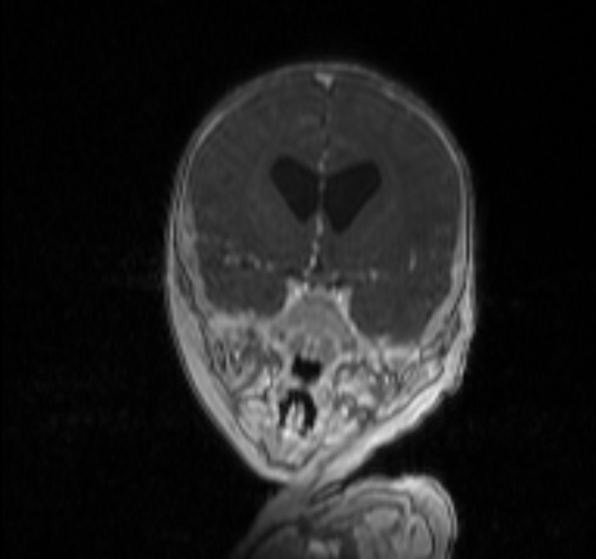 Chiari III malformation with occipital encephalocele (Radiopaedia 79446-92559 Coronal T1 C+ mpr 8).jpg