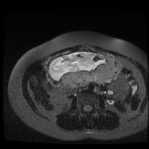 Chiari II malformation - fetal MRI (Radiopaedia 68099-77581 Axial T2-SSFSE 2).jpg