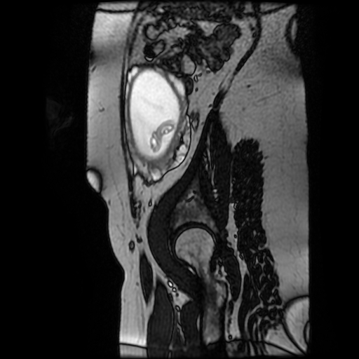 Chiari II malformation - fetal MRI (Radiopaedia 68099-77581 Sagittal Fiesta 7).jpg