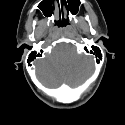 Chiari I malformation and obstructive hydrocephalus (Radiopaedia 41185-43981 D 28).png