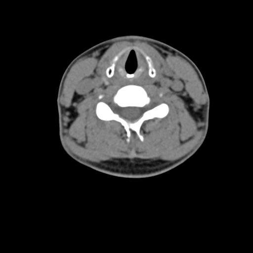 Chiari I malformation and obstructive hydrocephalus (Radiopaedia 41185-43981 D 60).png