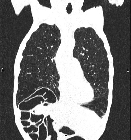 Chilaiditi sign (Radiopaedia 88839-105611 Coronal lung window 19).jpg