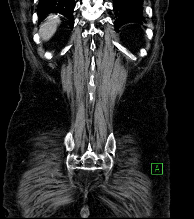 Cholangiocarcinoma with cerebral metastases (Radiopaedia 83519-98629 G 72).jpg