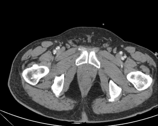 File:Cholecystitis - perforated gallbladder (Radiopaedia 57038-63916 A 83).jpg