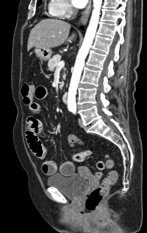 Cholecystoduodenal fistula due to calculous cholecystitis with gallstone migration (Radiopaedia 86875-103077 C 31).jpg