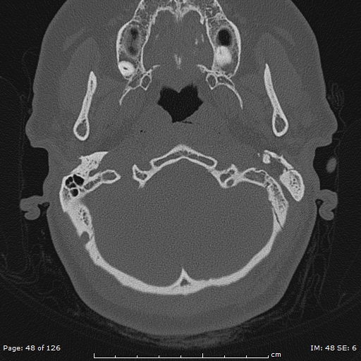 Cholesteatoma - external auditory canal (Radiopaedia 88452-105096 Axial bone window 11).jpg