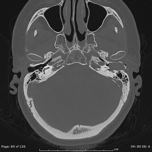Cholesteatoma - external auditory canal (Radiopaedia 88452-105096 Axial bone window 43).jpg