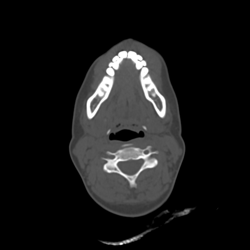 File:Chondroblastic osteosarcoma (Radiopaedia 67363-76741 Axial bone window 17).jpg