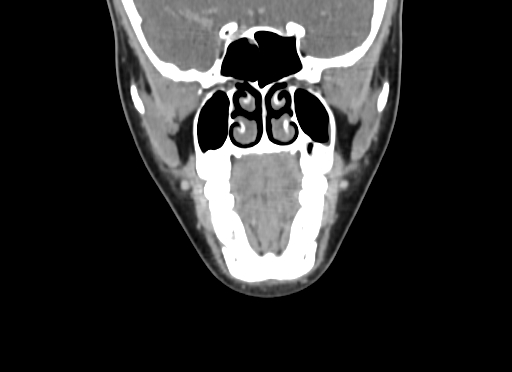 File:Chondroblastic osteosarcoma (Radiopaedia 67363-76741 D 39).jpg