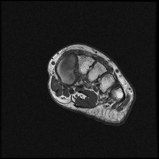 File:Chondroblastoma - midfoot (Radiopaedia 64831-73765 Short axis T1 18).jpg