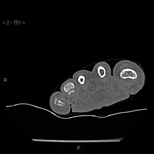 Chondrosarcoma - phalanx (Radiopaedia 69047-78812 Axial bone window 5).jpg