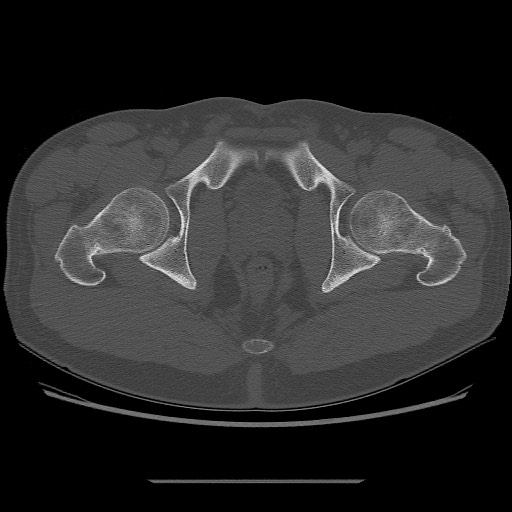 File:Chondrosarcoma of iliac wing (Radiopaedia 63861-72599 Axial bone window 109).jpg