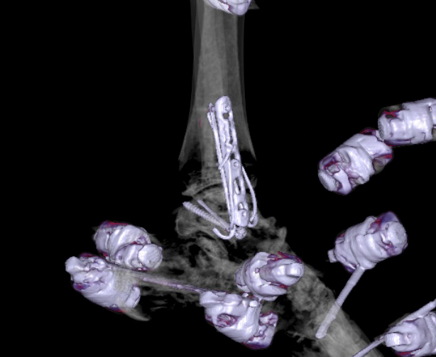File:Chopart fracture (Radiopaedia 35347-36861 3D MPR bone window 32).jpg