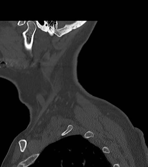 File:Chordoma (C4 vertebra) (Radiopaedia 47561-52188 Sagittal bone window 6).png