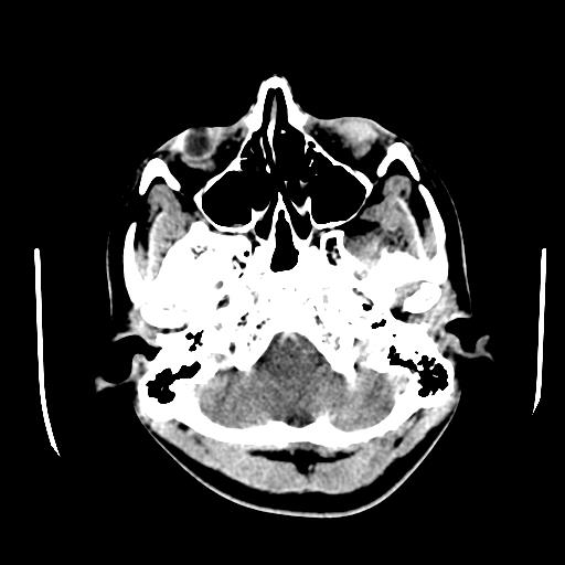 File:Choriocarcinoma of ovary with cerebral and pulmonary metastases (Radiopaedia 25983-26118 C+ arterial phase 12).jpg