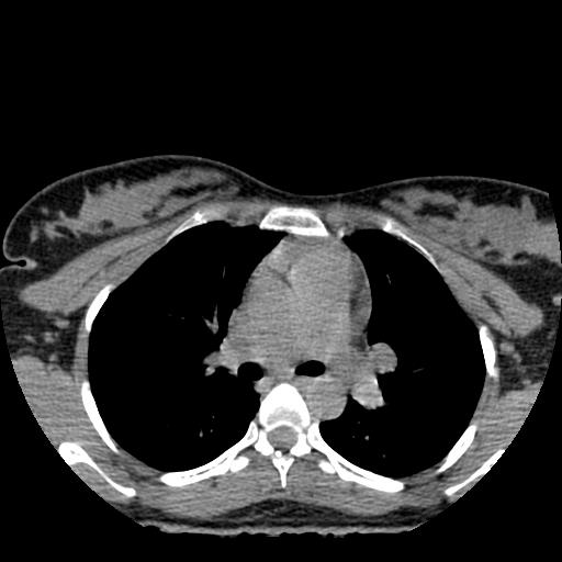 Choriocarcinoma of ovary with cerebral and pulmonary metastases (Radiopaedia 25983-26119 Axial non-contrast 124).jpg