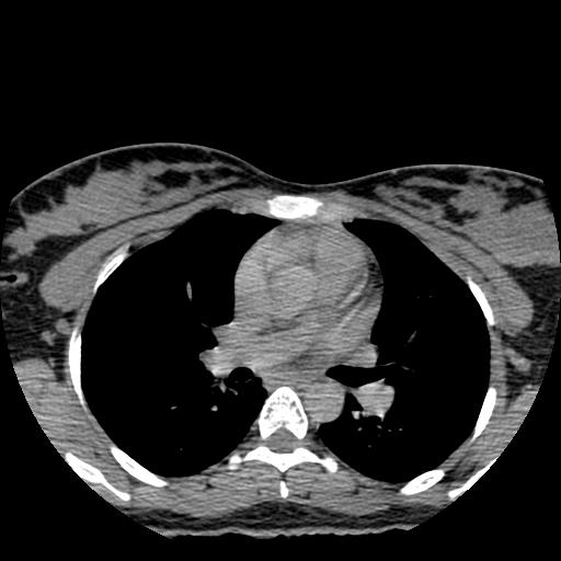 File:Choriocarcinoma of ovary with cerebral and pulmonary metastases (Radiopaedia 25983-26119 Axial non-contrast 132).jpg