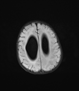File:Choroid plexus papilloma (Radiopaedia 84612-100019 Axial FLAIR 20).jpg