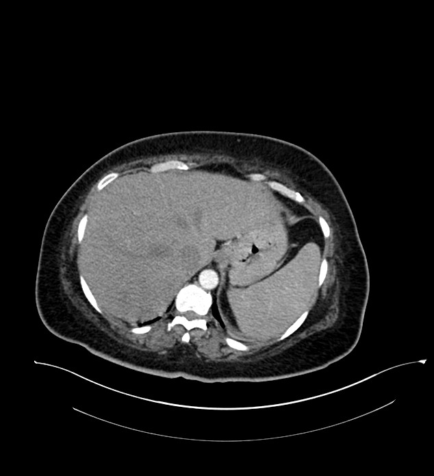 Chromophobe renal cell carcinoma (Radiopaedia 84239-99519 B 13).jpg