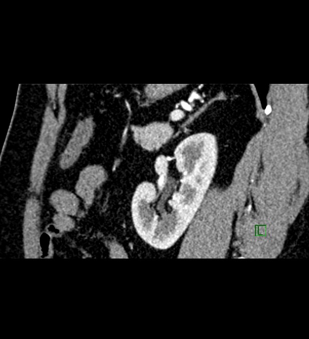 Chromophobe renal cell carcinoma (Radiopaedia 84286-99573 F 51).jpg