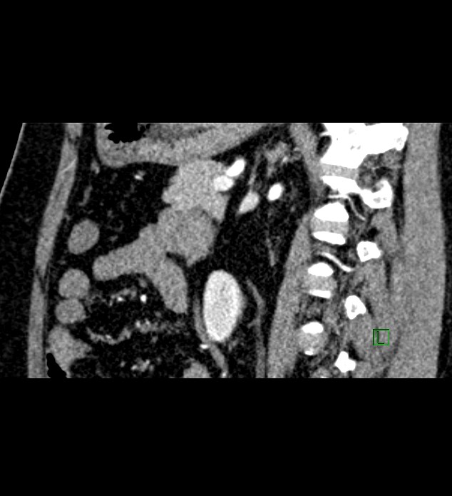 Chromophobe renal cell carcinoma (Radiopaedia 84286-99573 F 68).jpg
