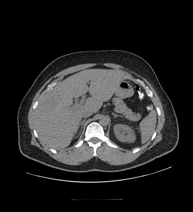 Chromophobe renal cell carcinoma (Radiopaedia 84337-99644 Axial non-contrast 25).jpg