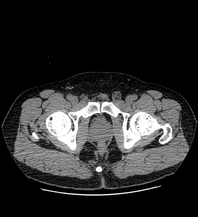 Chromophobe renal cell carcinoma (Radiopaedia 84337-99693 Axial non-contrast 159).jpg