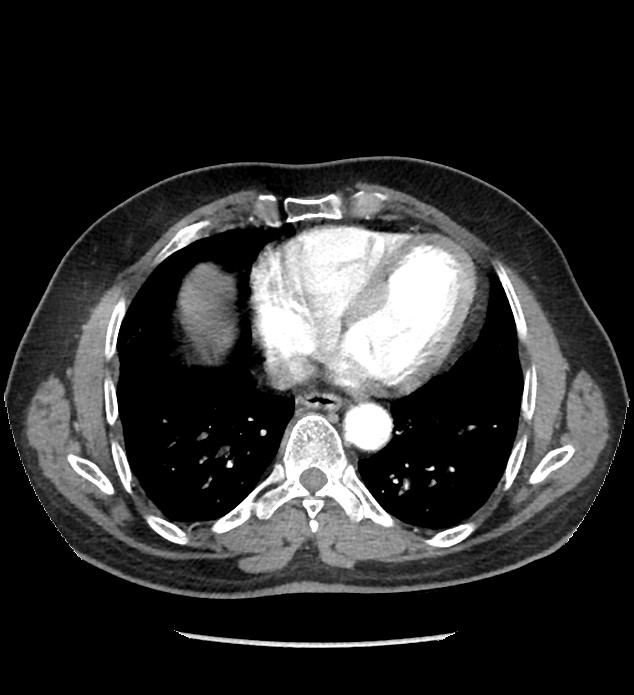 Chromophobe renal cell carcinoma (Radiopaedia 86879-103083 B 5).jpg