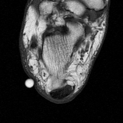 File:Chronic Achilles tendon rupture (Radiopaedia 15262-15100 Axial T1 21).jpg