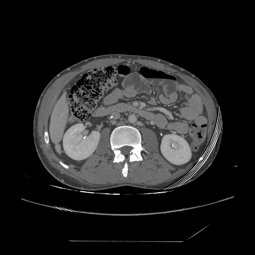 File:Chronic IVC thrombosis and resultant IVC filter malposition (Radiopaedia 81158-94800 A 94).jpg