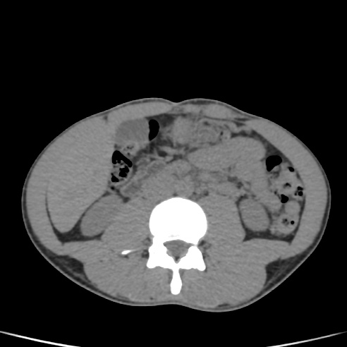 File:Chronic calcific pancreatitis (Radiopaedia 56280-62953 Axial non-contrast 33).jpg