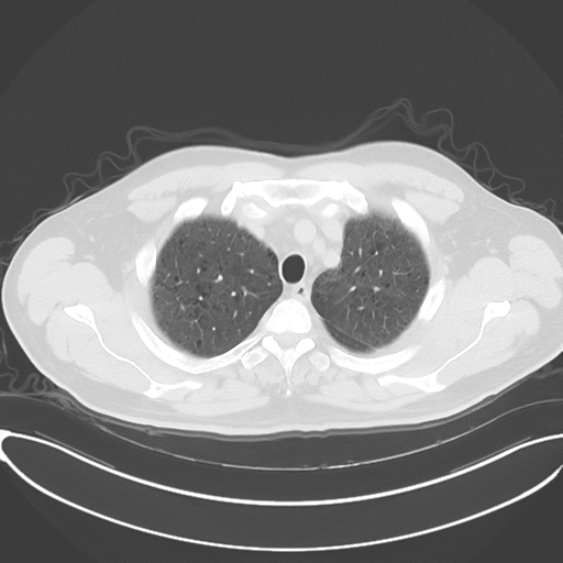 Chronic hypersensitivity pneumonitis (Radiopaedia 48107-52922 Axial lung window 15).png