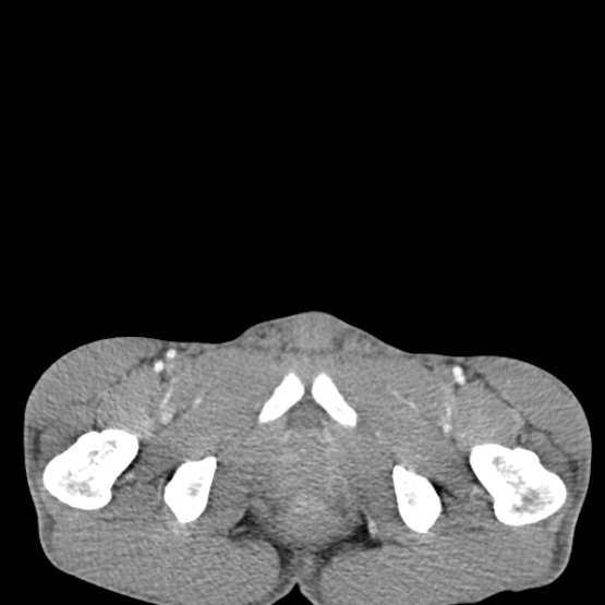 Chronic large bowel pseudo-obstruction (Radiopaedia 43181-46492 A 165).jpg