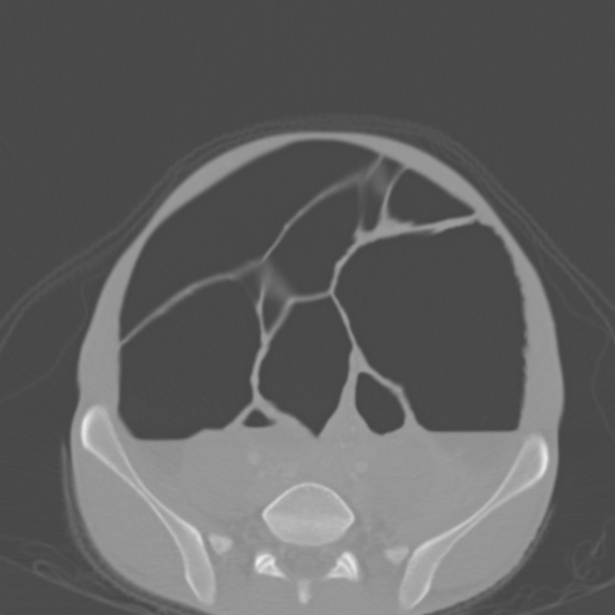 Chronic large bowel pseudo-obstruction (Radiopaedia 43181-46492 Axial bone window 124).jpg