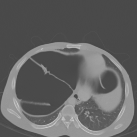 Chronic large bowel pseudo-obstruction (Radiopaedia 43181-46492 Axial bone window 31).jpg