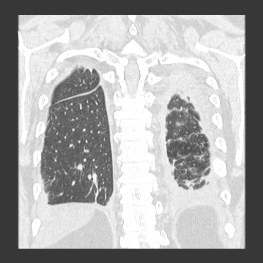 Chronic lung allograft dysfunction - restrictive form (Radiopaedia 60595-68316 Coronal lung window 77).jpg