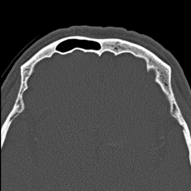 Chronic maxillary sinusitis (Radiopaedia 27879-28116 Axial bone window 49).jpg