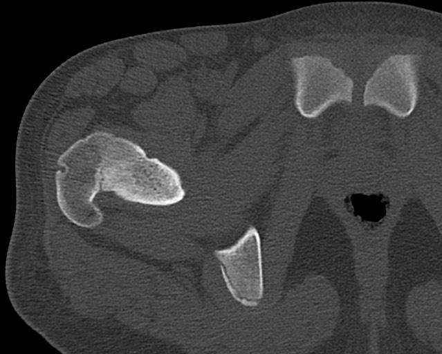 Chronic ostemyelitis of the femur with long sinus tract (Radiopaedia 74947-85982 Axial bone window 8).jpg