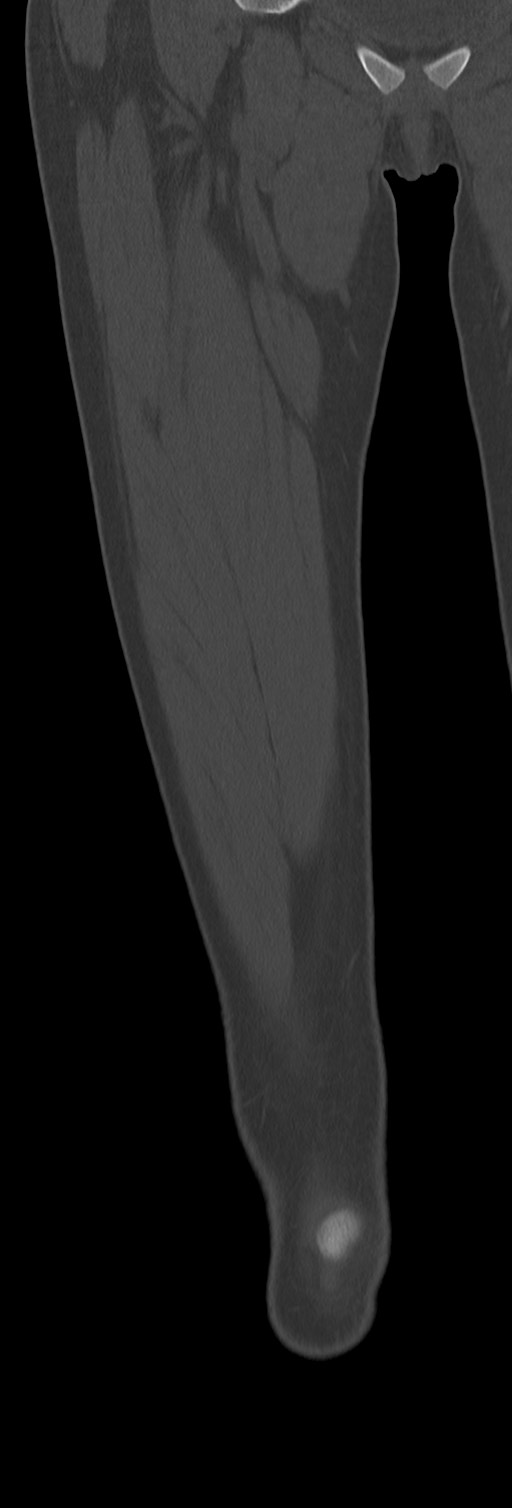 Chronic ostemyelitis of the femur with long sinus tract (Radiopaedia 74947-85982 Coronal bone window 24).jpg