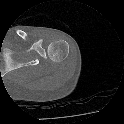 Chronic osteomyelitis (Radiopaedia 67597-76998 Axial bone window 5).jpg