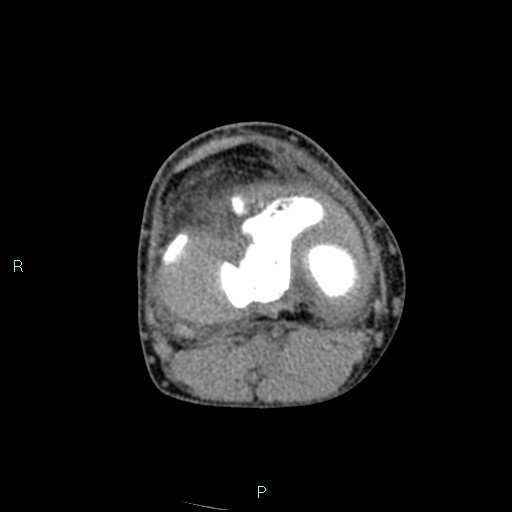 Chronic osteomyelitis (with Brodie abscess) (Radiopaedia 76405-88111 A 110).jpg