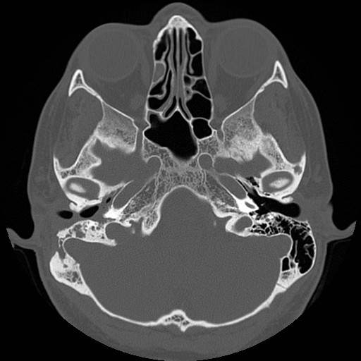 File:Chronic otomastoiditis (Radiopaedia 27138-27309 Axial bone window 26).jpg