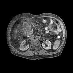 File:Cirrhosis and hepatocellular carcinoma in the setting of hemochromatosis (Radiopaedia 75394-86594 Axial T1 C+ fat sat 25).jpg